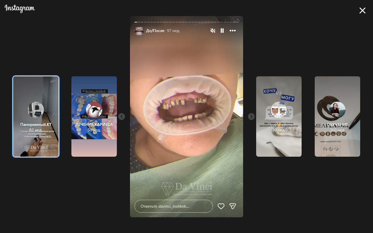 Имплантация зубов