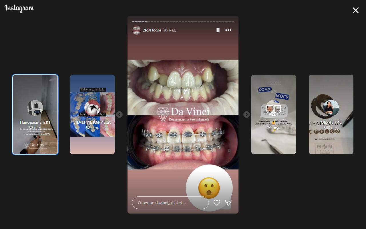 Результат ортодонтии