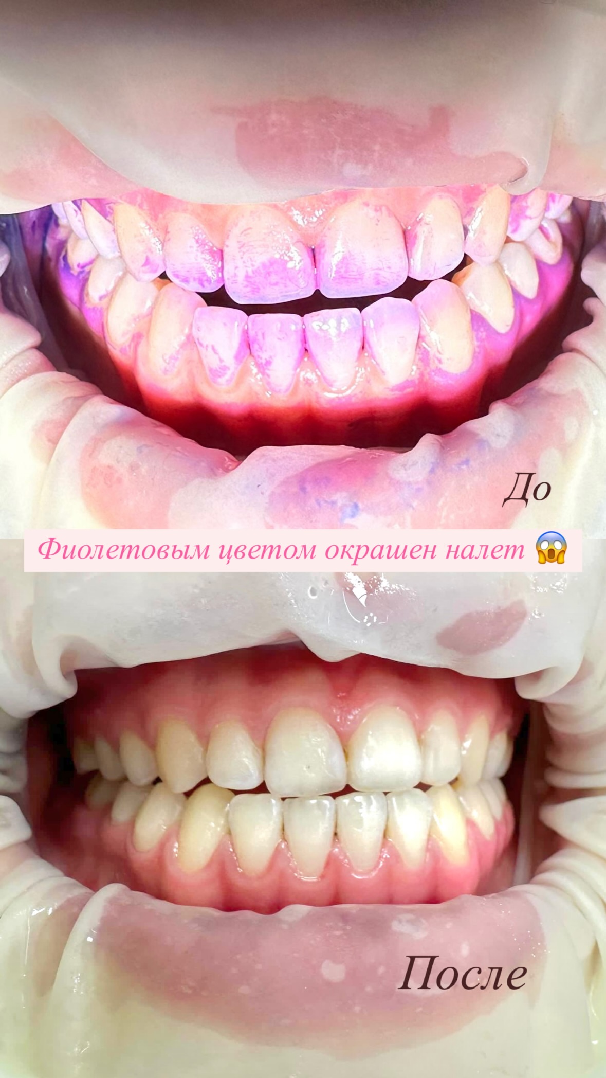 Чистка зубов