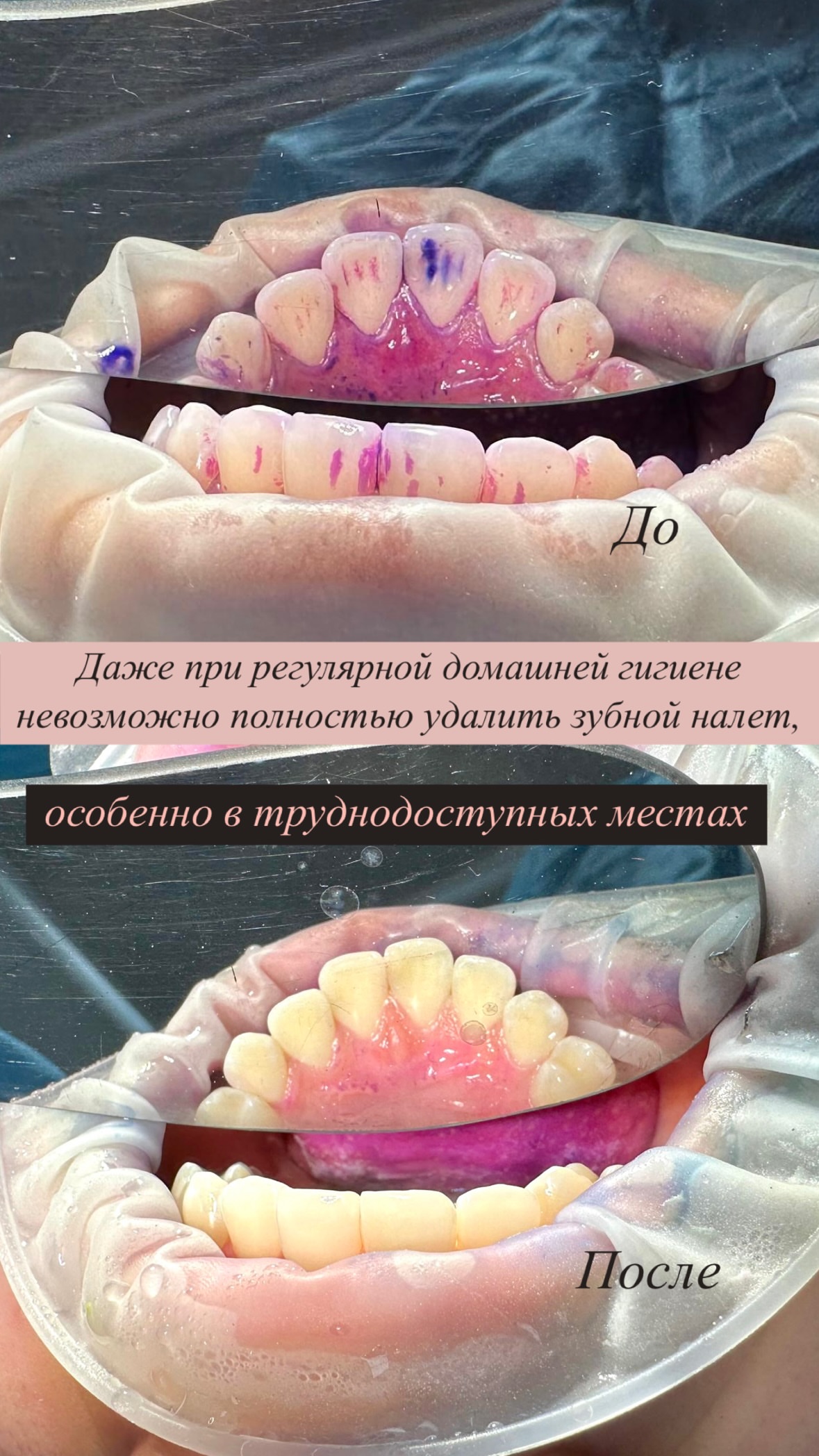 Чистка зубов