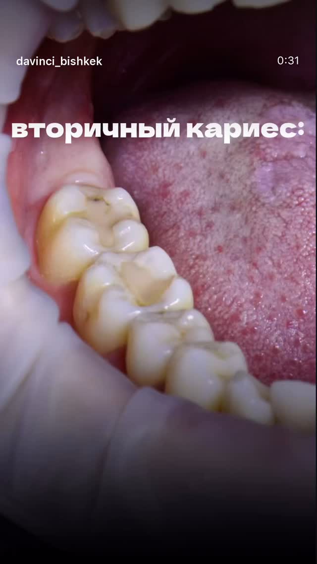 Лечение кариеса