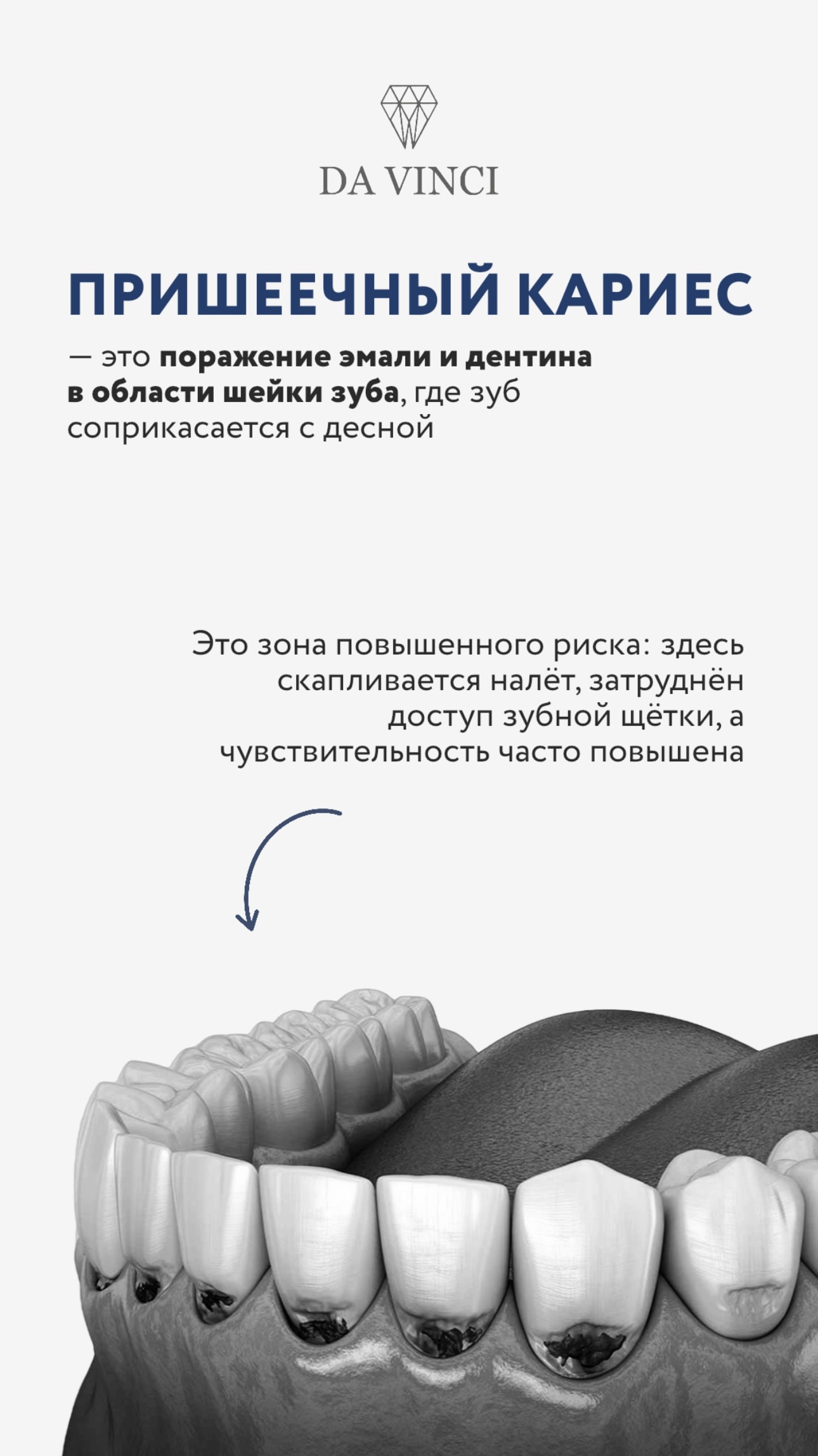 Лечение кариеса