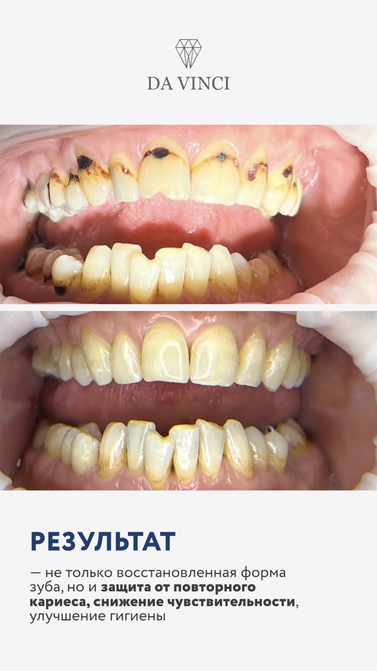 Лечение кариеса