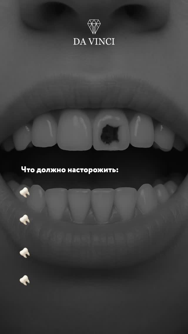 Лечение кариеса