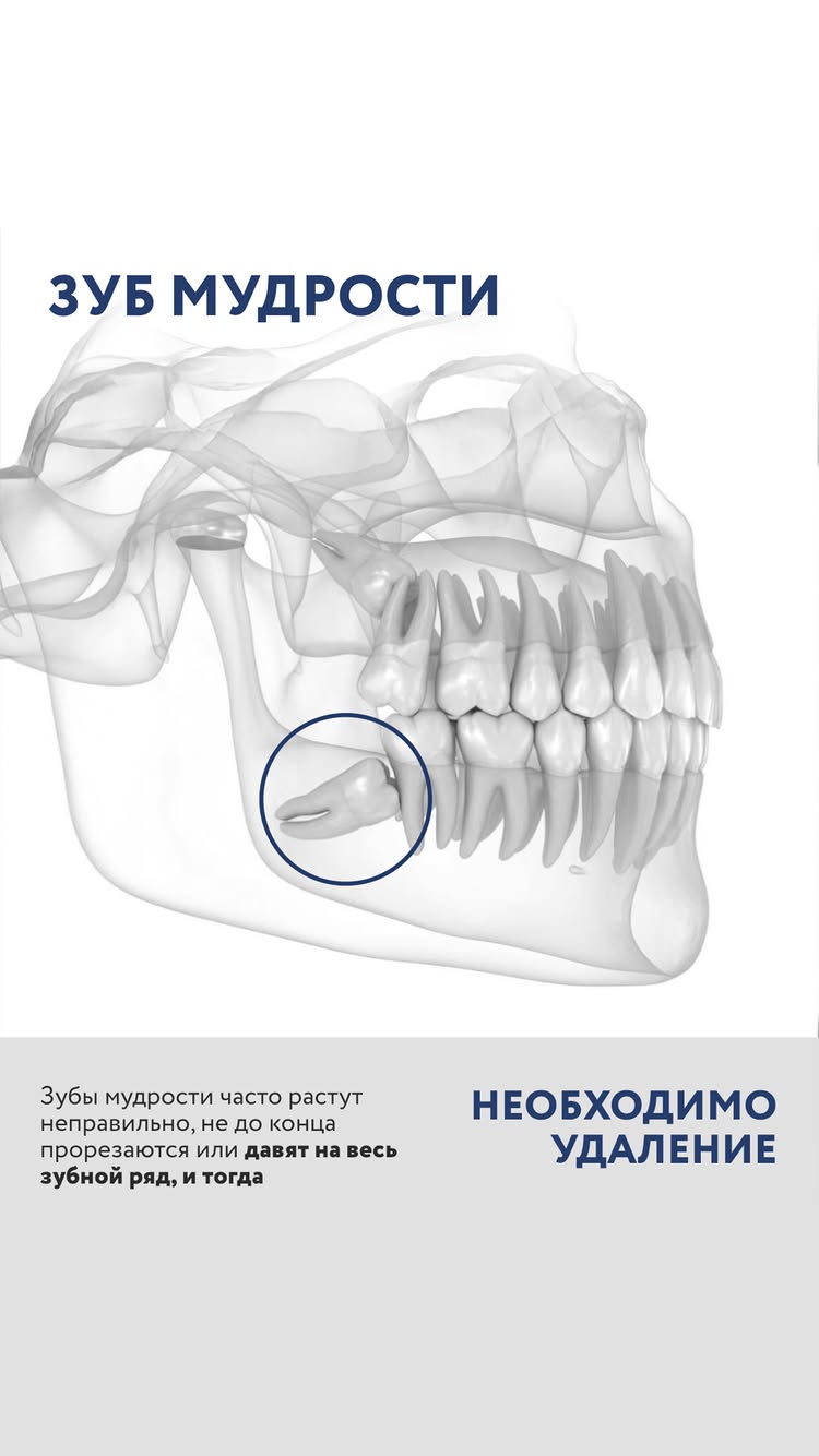 Удаление зубов мудрости