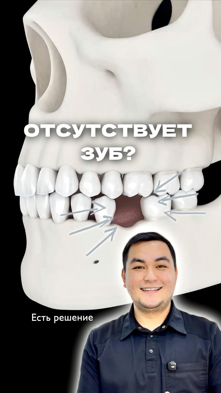 Имплантация зубов